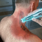 Muskelmassage Therapie Akupunktur Punkt Stift